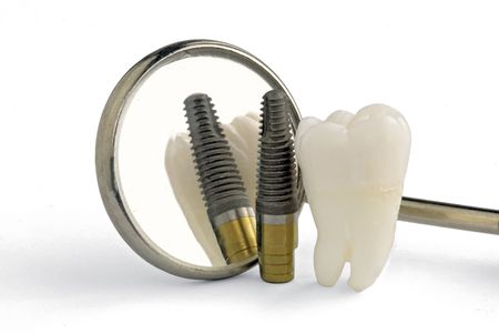 Human tooth, titanium implant, dental mirror close up