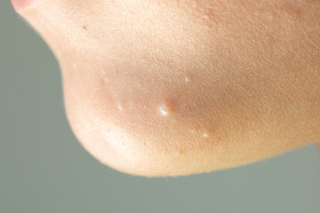 Close-up of Molluscum Contagiosum also called water wart. Viral formations in the chin on the skin of the child. Maternal plaque is in the center and small later rash around. health care.の写真素材