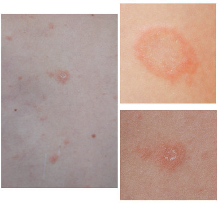 Collage of Pityriasis Rosea rash. Left side is rush on the back, top right is maternal plaque, bottom right is rash three weeks after the appearance of the first focus. Gibera Syndrome.の写真素材