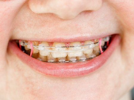 Close up of a teenage girl smiling mouth in orthodontic brackets on tetth and and orthodontic elastic rubber. Girl with braces on teeth. Orthodontic treatment.の写真素材
