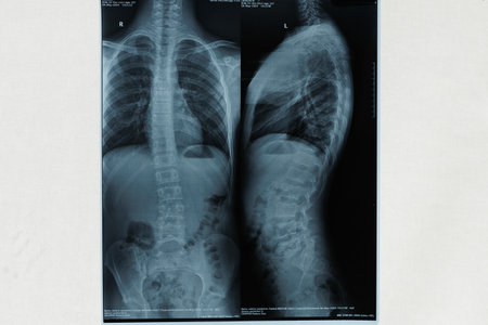 X-ray of whole spine AP and Lateral position in dark background. curvature of the spine in the thoracic region scoliosis.の写真素材