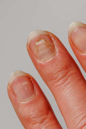 Injured finger nail after cut. Healed scar on the finger nail plate, close up on white background, verticalの写真素材