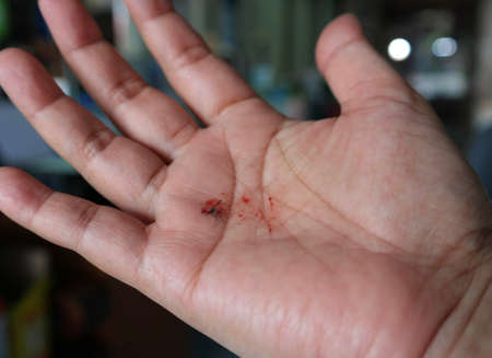 dead mosquito with red blood on human palm in houseの写真素材