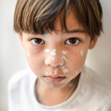 Young kid at home sick with chicken pox, white and green antiseptic cream applied to the rash