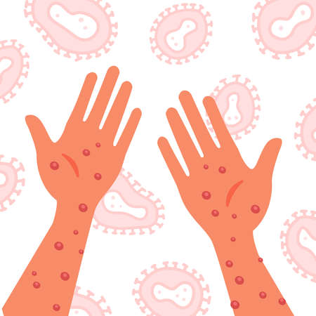 Human hands with monkeypox virus on the microscopic background of the virus. Vector flat hand drawn...