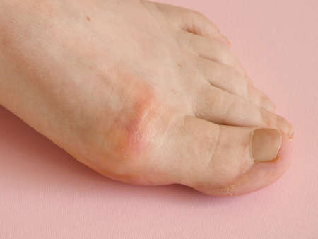 woman's hand massaging her bunion toes in bare feet to relieve pain on pink background Woman feet...