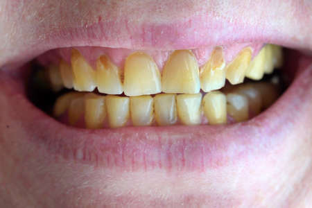 a woman smiles, lips and teeth with plaque and caries, woman's mouth macro