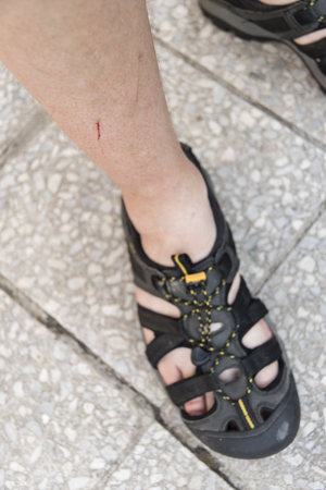 Scratch on a male leg.の写真素材