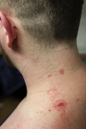 Oil Burns On The Skin Of The Neck.