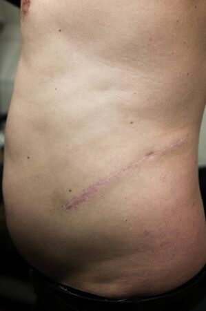 Long scar on the side of the abdomen.