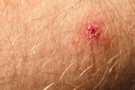 Torn pimple on human skin in macro detail.の写真素材