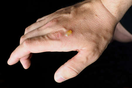 A small blister after burning the back of the hand.の写真素材