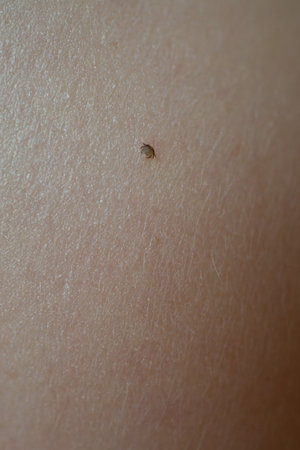 A miniature tick biting into the skin.