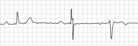 Electrocardiogram waveform with grid background. Vector representation of cardiac activity for...