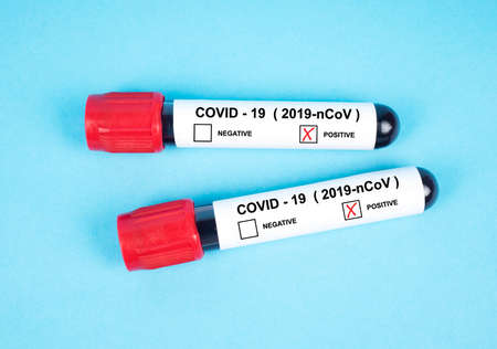 Coronavirus 2019-nCoV test blood samples