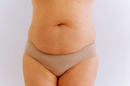 sagging skin with age spots on fat belly, plastic surgery conceptの写真素材