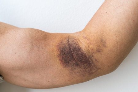 injury ligament arm bruiseの写真素材