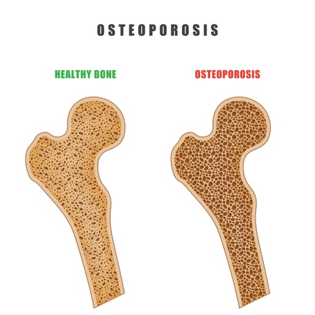 Color drawing of human thigh bone with osteoporosis problem on white background. Two bones are normal and sore. Vector illustration of the medical problem of osteoporosis diseaseのイラスト素材
