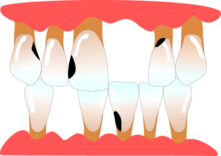 front teeth with tooth gaps, caries and periodontitisの写真素材