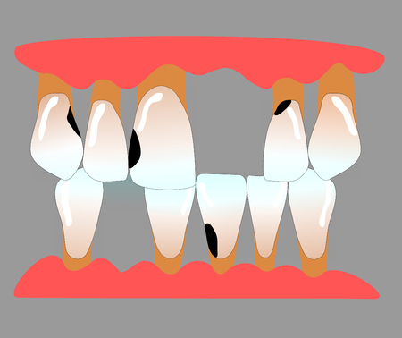 front teeth with tooth gaps, caries and periodontitisの写真素材