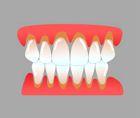 front teeth with periodontitisの写真素材