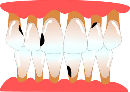 front teeth with caries and periodontitisの写真素材