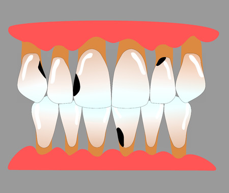 front teeth with caries and periodontitisの写真素材