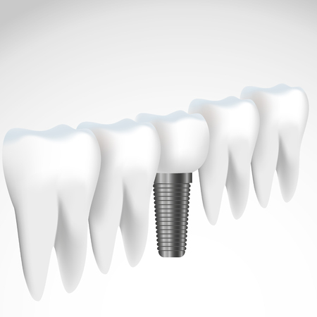 3d realistic Bolts and screws Concept Dental Clinicのイラスト素材