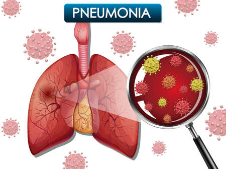 Poster design for pneumonia with human lungs and virus cells illustrationのイラスト素材
