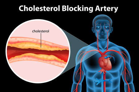 Illustration showing the process of ateriosclerosisのイラスト素材