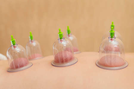 close up patient experiencing cupping therapy. High quality photo