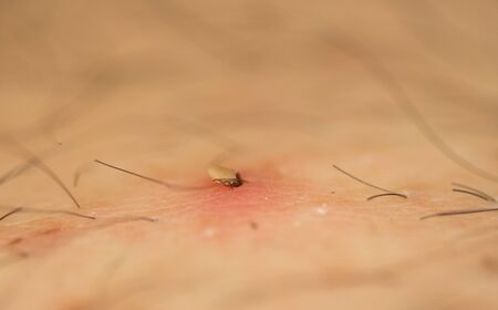 tick caught in the body, Ixodes ricinus.The tick sucked into the human skinの写真素材