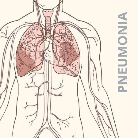 A schematic image of the human body and internal organs of the lungs with an infographic of the symptoms of pneumonia on the human lungs. The vector is hand-drawn.のイラスト素材