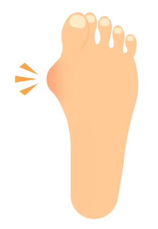 Foot with hallux valgus onset.の写真素材