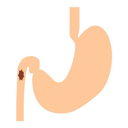 Duodenal ulcerの写真素材