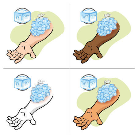 Illustration representing First Aid with ice compress on the injured armのイラスト素材