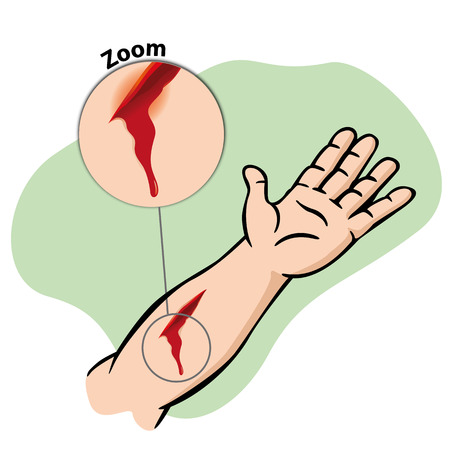 Illustration First Aid injured arm with bleeding gash. Ideal for catalogs newsletters and first aid guidesのイラスト素材
