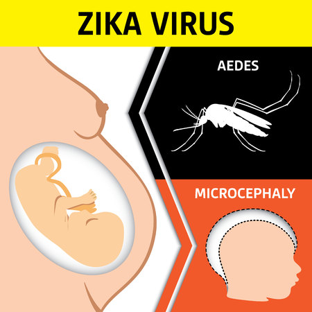 Illustration of a pregnant with Zika Virus and newborn baby with microcephaly disease, Aedes. Ideal for informational and institutional related sanitation and medicineのイラスト素材