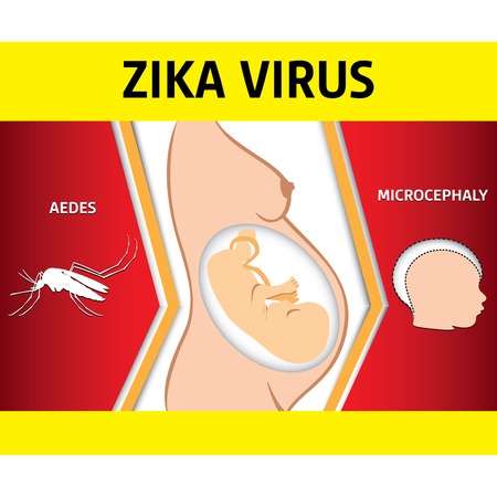 Illustration of a pregnant with Zika Virus and newborn baby with microcephaly disease, Aedes. Ideal for informational and institutional related sanitation and medicineのイラスト素材