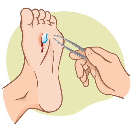 Person injured foot with broken glass, pulling with forceps, caucasian. Ideal for catalogs, informational and institutional guidesのイラスト素材