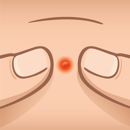 Illustration first aid of fingers squeezing an acne, Caucasian. Ideal for medical, informative and institutional catalogsのイラスト素材