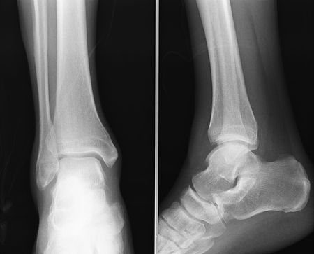 x-ray of an elbowの写真素材