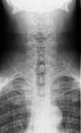 x-ray image of a neck from front perspectiveの写真素材