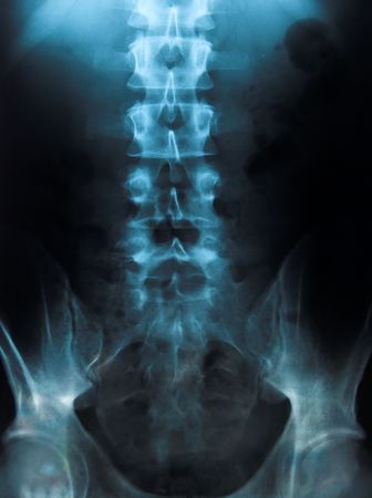 Radiography of a young male spineの写真素材