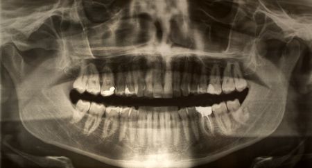 Panoramic dental x-ray of a young adult male