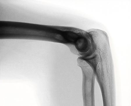 radiography of a young male bended armの写真素材