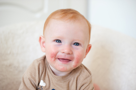 Manifestation of an allergy on the face of the childの写真素材