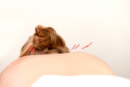 Female patient with acupuncture needles along the Shu Points on the back.の写真素材