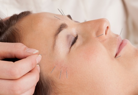 Woman receiving facial acupuncture treatmentの写真素材