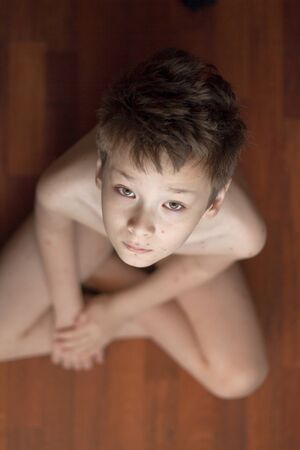 Poor boy with chickenpox. Sad little boy itching the body. Chickenpox rashの写真素材